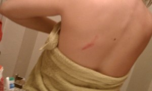 wounded